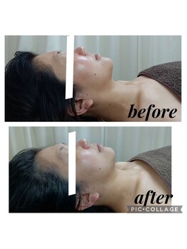 クリオネ(Clione)/BBL光フェイシャル