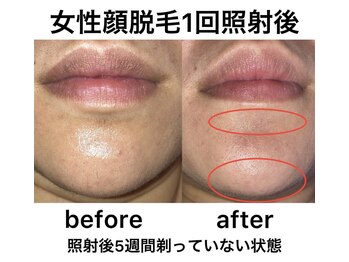 猫の手/【美肌脱毛】顔(女性)