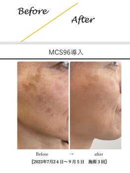 リセット(RESET)/幹細胞＋エクソソーム