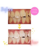 エクシアホワイトニング 札幌中島公園店/BeforeAfter［ホワイトニング］ 