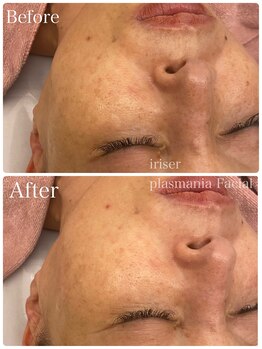 イリゼ(iriser)/プラズマフェイシャル