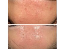 レヴール 京都四条烏丸店(Reveur)/花粉や黄砂による肌荒れ