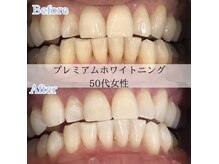 ホワイトニングカフェ 藤が丘店(WhiteningCafe)/プレミアムホワイトニング☆