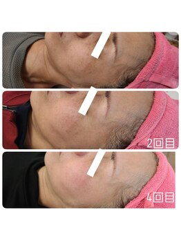 キレイ(KIREI)/シミケアビフォーアフター