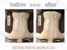 エステプリヴェモロッコ(ESTHE PRIVE MOROCCO)/カッサ+スライドカッピング