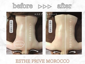 エステプリヴェモロッコ(ESTHE PRIVE MOROCCO)/カッサ+スライドカッピング