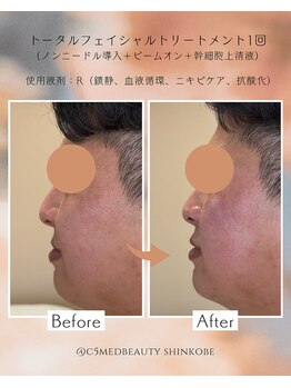 シーファイブメッドビューティ 新神戸店(C5medビューティ)/ビフォーアフター