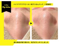 イエス マイサロン(yes My Salon)/ハイドラアクアピール症例