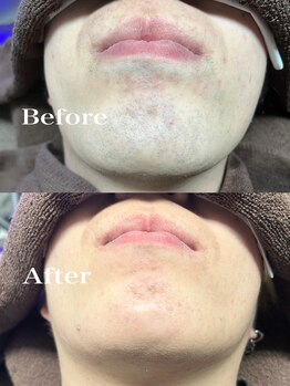 ツール(TOOL)/ヒゲ脱毛