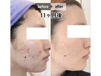 グランピピ(Grand PiPi)/肌「ニキビ」改善