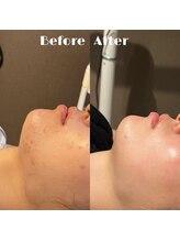 #美容革命ラボ 福岡春吉店/ハーブピーリング【春吉・天神】