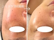 ラペッシュボーテ(La Peche Beaute)の雰囲気（長年のシミ改善が得意★トーンまで整う！土台から見直し◎）
