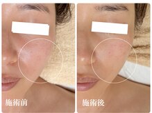 キーオブフェイス(Key of Face)/お悩み【ほうれい線】