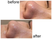 1回で毛穴の黒ずみ解消！毛穴洗浄アクアピュア使用