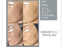 肌質改善 Shining Star 梅田店 ハーブピーリング/毛穴/ニキビケア/シミしわ/艶肌WAX