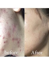 ベルシャトン(Belle Chaton)/HAABREPRO ニキビ改善