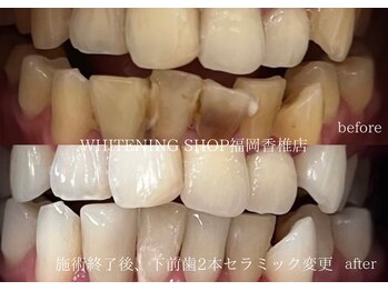 ホワイトニングショップ 福岡香椎店/美容ホワイトニングbefore after