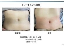 トラレス(Trouless)/脂肪冷却