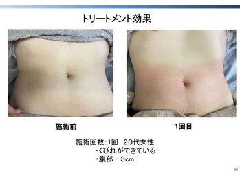 トラレス(Trouless)/脂肪冷却