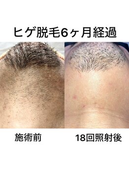 猫の手/【美肌脱毛】髭(男性)