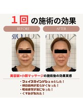 クローバー鍼灸整骨院/美容鍼＋小顔矯正マッサージ