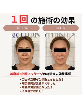 クローバー鍼灸整骨院/美容鍼＋小顔矯正マッサージ