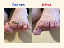 ピース/厚くなった爪にお悩みの60代女性