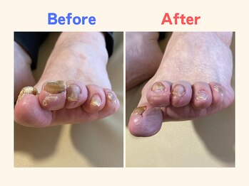 ピース/厚くなった爪にお悩みの60代女性