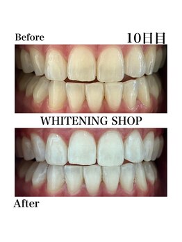 ホワイトニングショップ 豊川店/Before After　10日目のお客様
