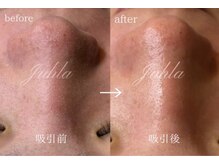 ユフラ(Juhla)/韓国式3D毛穴洗浄＋ララピール