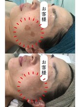 ルル(Lulu's)/シミケア6回目施術結果