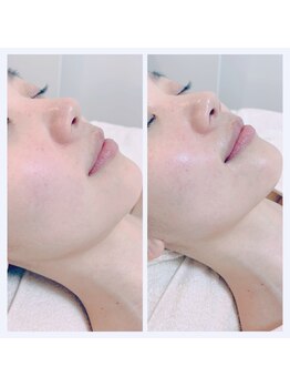 ブリス(Bliss)/神美顔器エクラボーテ半顔10分