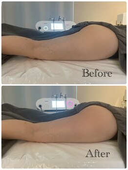 レスピロン(Respirons)/