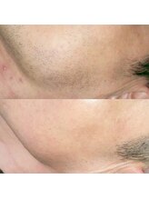 メイプル(Maple)/毎日の髭剃りから卒業しませんか