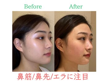 ラプリ 福岡博多店(Raplit)/隆鼻+輪郭・小顔矯正 美鼻/小顔