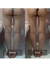 サリーサロン(SallySalon)/スーパーセルムRF+