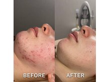 〈大人気〉国産100％最高品質ハーブピーリング/肌質ニキビ改善