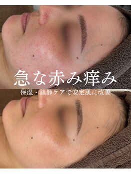 インテリウス(INteRius.)/再発のない肌質改善