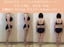 エターナルフレーム(Eternal Flame)/26歳トリプル全身痩身20回コース