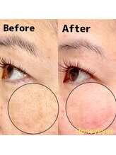 ハニーアイズ(Honey Eyes)/女性フェイシャルwax脱毛