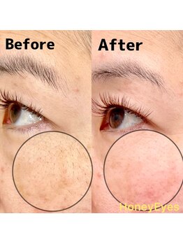 ハニーアイズ(Honey Eyes)/女性フェイシャルwax脱毛