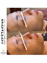 アクシア ビューティー サロン(AXSIA)/【ハイドラ】BeforeAfter