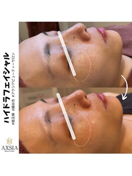 アクシア ビューティー サロン(AXSIA)/【ハイドラ】BeforeAfter
