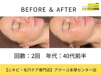 ア クーユ 多摩センター店/ レモンボトル/二重あご/小顔