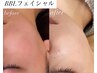 【特別価格】BBLフェイシャル 1回 ¥10000→¥7900 男性にも人気◎