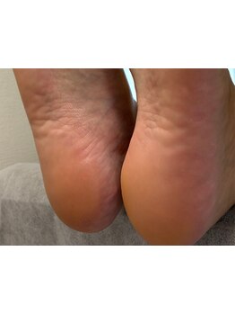 角質ケアができるサロン