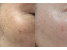 ホノン(Honon)の雰囲気（1～3レベルアップ式の素晴らしいエイジングケア♪シミ改善にも！）