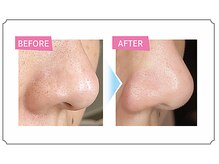 プレジール(Plaisir)/毛穴ケア/ハイドロフェイシャル