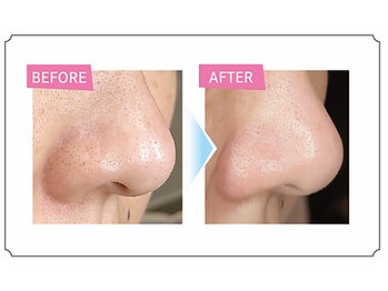 プレジール(Plaisir)/毛穴ケア/ハイドロフェイシャル