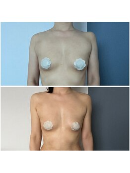 モア(moa)/40代バスト2回目